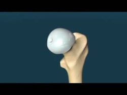 Hip arthroplasty animation