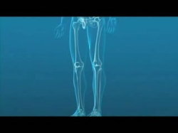 Knee arthroplasty -animation