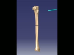 External fixation treatment-animation